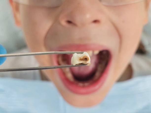Best Emergency Tooth Extraction in Cloverdale, VA
